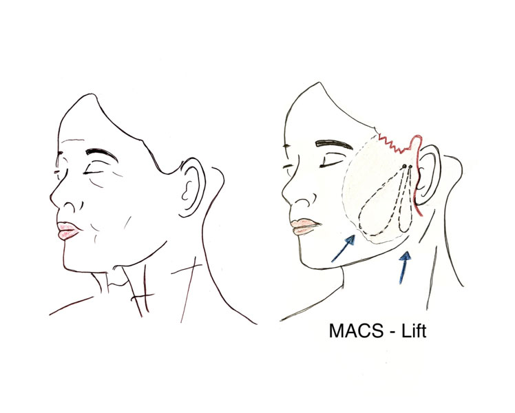 Mituri despre liftingul facial
