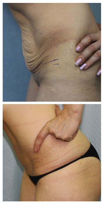 abdominoplastie