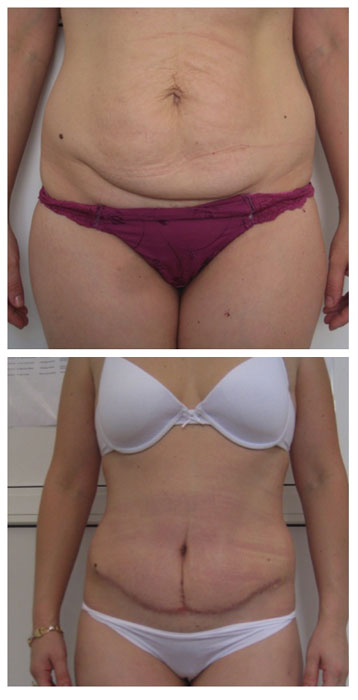 abdominoplastie