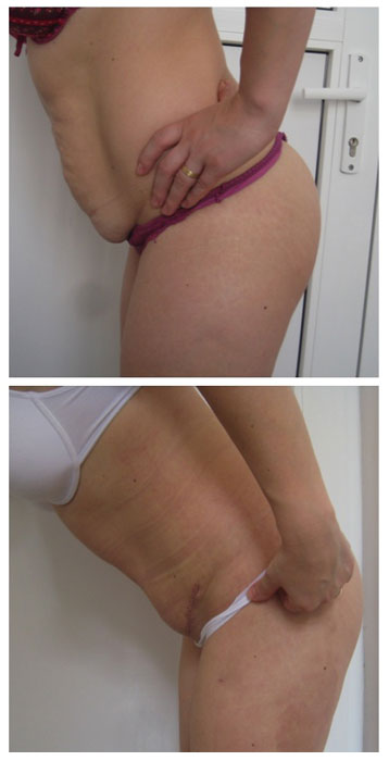 abdominoplastie