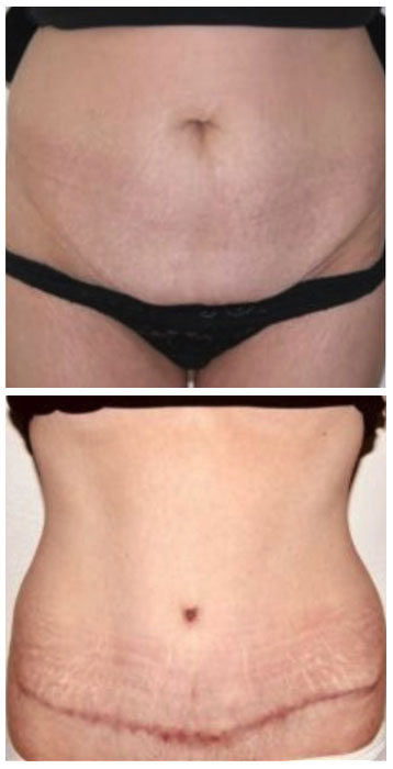 abdominoplastie