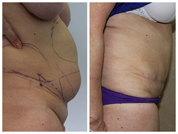 lipoabdominoplastie