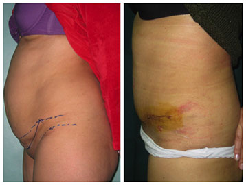 lipoabdominoplastie
