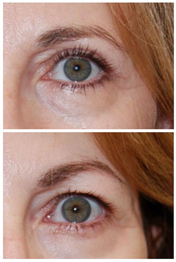 blefaroplastie superioara