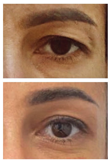 blefaroplastie superioara