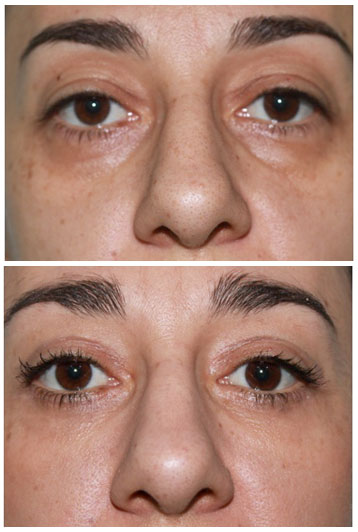 blefaroplastie superioara si inferioara