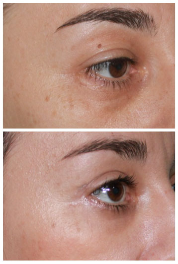 blefaroplastie superioara si inferioara