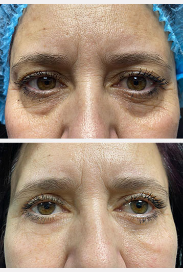 blefaroplastie superioara