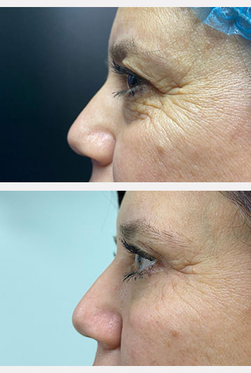 blefaroplastie superioara