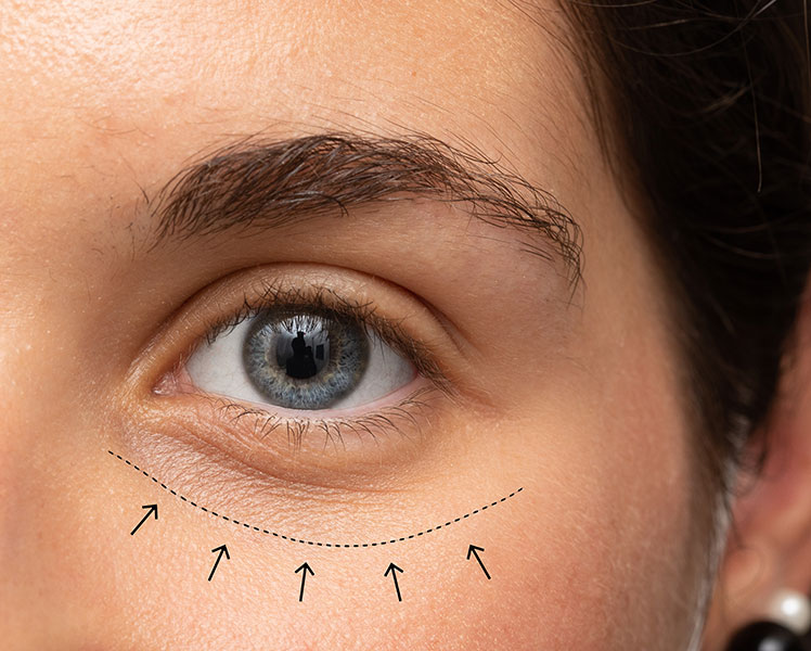 blefaroplastie