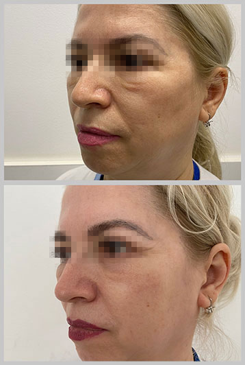 lifting facial cu fire aptos