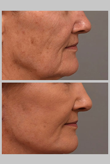 lifting facial
