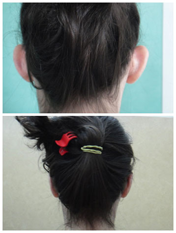 otoplastie