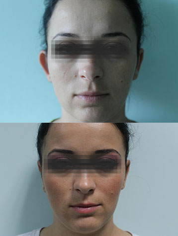 otoplastie