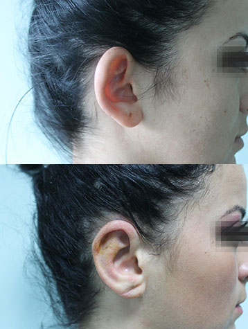 otoplastie