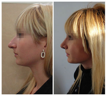 rinoplastie