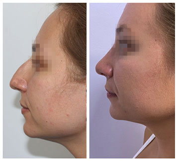 rinoplastie