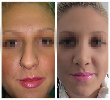 rinoplastie