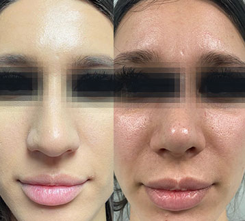 rinoplastie