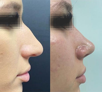 rinoplastie