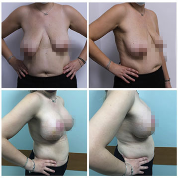 augmentare mamara cu mastopexie